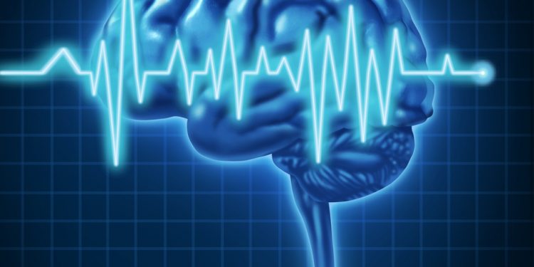 CVA poate provoca un accident vascular cerebral? – Oren Zarif